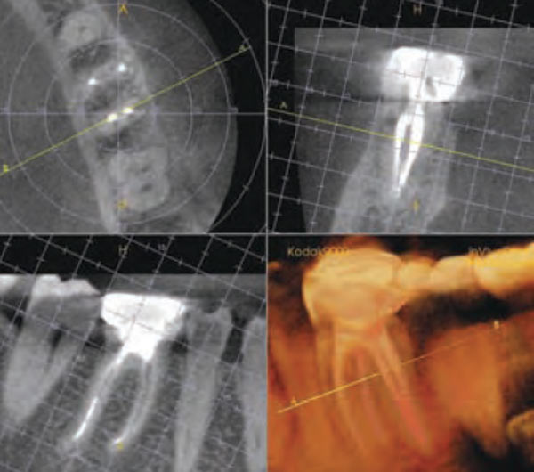 مبادئ الجراحة اللبية المجهرية Principles of microscopic endodontic surgery 2107