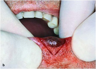 أسباب الضياع المادي للشفة  Physical causes loss of the lip 2221