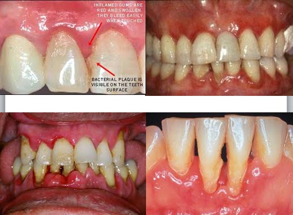 تصنيف الأمراض حول السنية Classification of periodontal diseases  5635