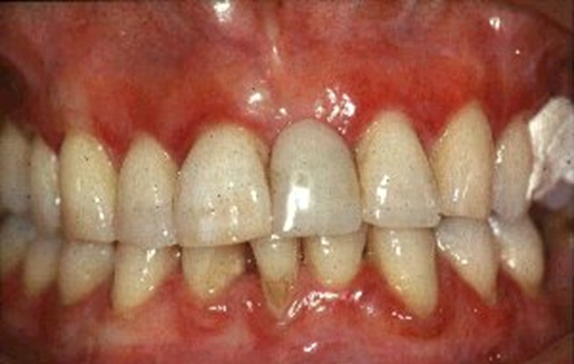 تصنيف الأمراض حول السنية Classification of periodontal diseases  5637