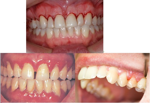 تصنيف الأمراض حول السنية Classification of periodontal diseases  5638