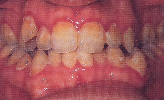 تصنيف الأمراض حول السنية Classification of periodontal diseases  5640
