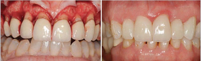 تصنيف الأمراض حول السنية Classification of periodontal diseases  5641