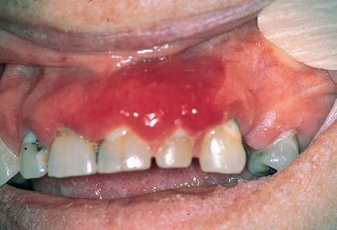 تصنيف الأمراض حول السنية Classification of periodontal diseases  5642
