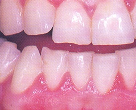 تصنيف الأمراض حول السنية Classification of periodontal diseases  5643