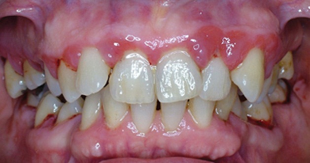 تصنيف الأمراض حول السنية Classification of periodontal diseases  5644