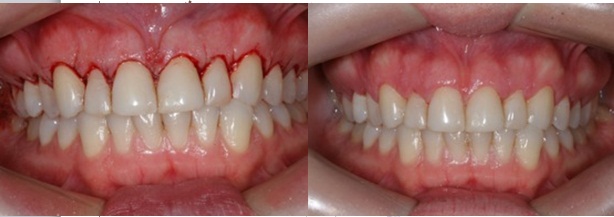 تصنيف الأمراض حول السنية Classification of periodontal diseases  5645