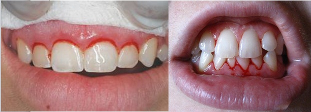 تصنيف الأمراض حول السنية Classification of periodontal diseases  5646