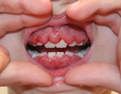 تصنيف الأمراض حول السنية Classification of periodontal diseases  5650