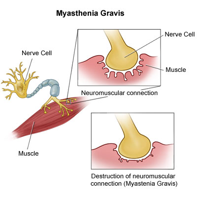 myasthenia gravis images. What Causes Myasthenia Gravis